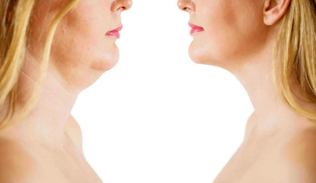 Double Chin treatment Milton Keynes before and after results
