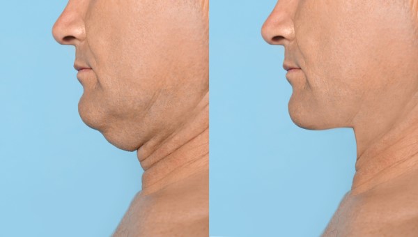 Which Non-Surgical Treatments Work Best for Jowls and Loose Skin Milton Keynes?