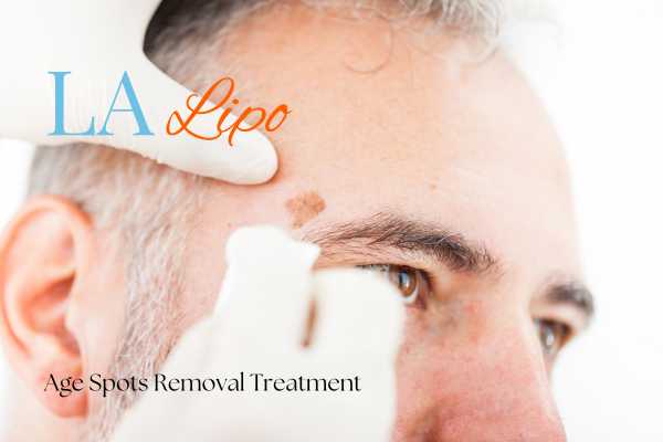 What Are the Most Effective Treatments for Age Spots Milton Keynes?