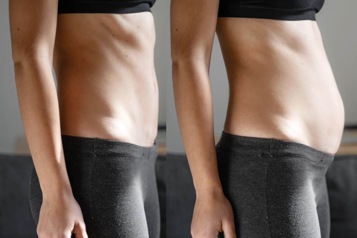 How long does diastasis recti take to improve Milton Keynes?