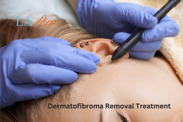 Dermatofibroma Removal Treatment Milton Keynes