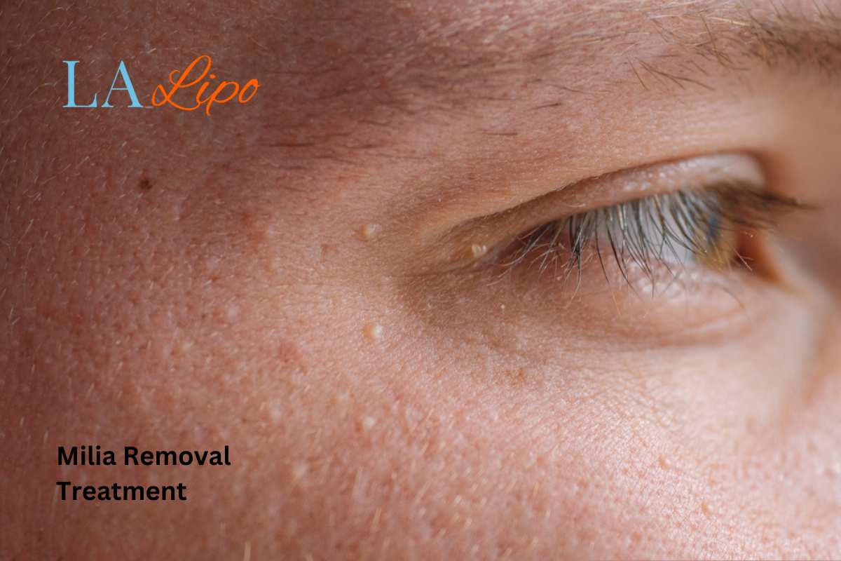 Cryopen Milia Removal: Is It the Easiest and Safest Option Milton Keynes?