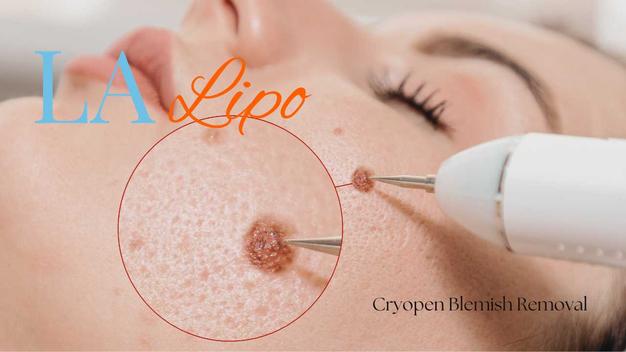 cryopen blemish removal Milton Keynes Contact our team today!