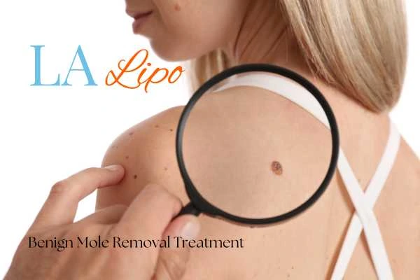 Woman having her inspection of blemish before mole removal Milton Keynes