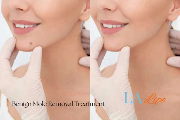 woman's before and after mole removal Milton Keynes results