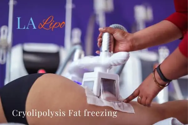 women getting fat freezing Milton Keynes