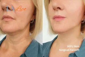 hi-fu for wrinkles Milton Keynes before and after results