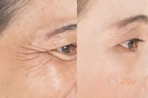 Before and after results of woman - HI-fu wrinkles reduction treatment Milton Keynes