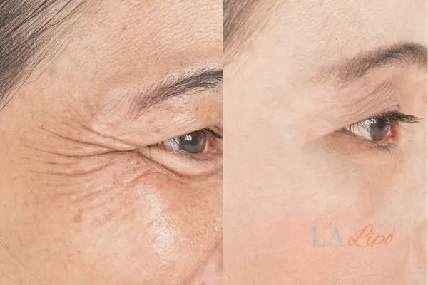 Before and after results of woman - HI-fu wrinkles reduction treatment Milton Keynes