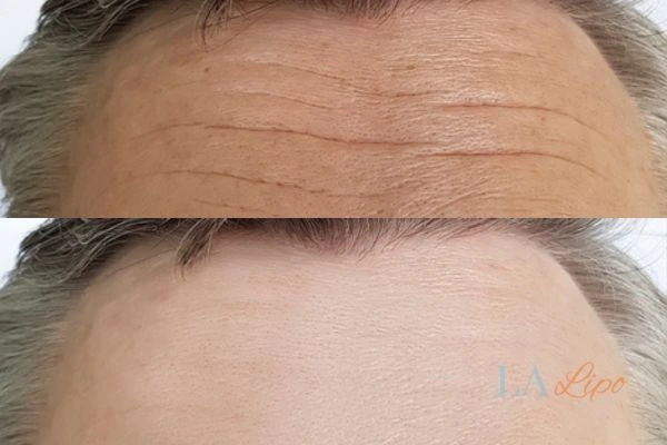 results of HIFU Milton Keynes on mans forehead to help reduce lines and wrinkles