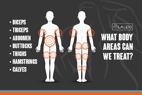Graphic to show areas you can have LA-EMS Body Sculpting Milton Keynes treatment.