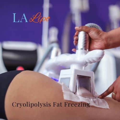 fat freezing - Cryolipolysis Milton Keynes