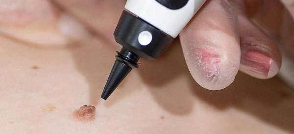skin tag removal using cryopen Milton Keynes