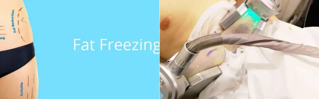 Fat freezing Milton Keynes on multiple areas of the body