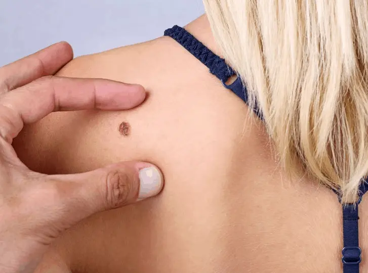 woman having mole removal Milton Keynes consultation before treatment.