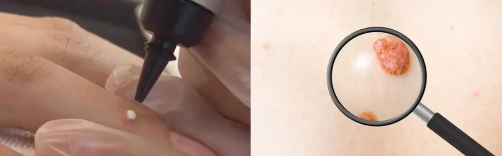 Cryopen for mole removal Milton Keynes - speak to our team today!
