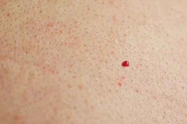 close up of a cherry angioma Milton Keynes