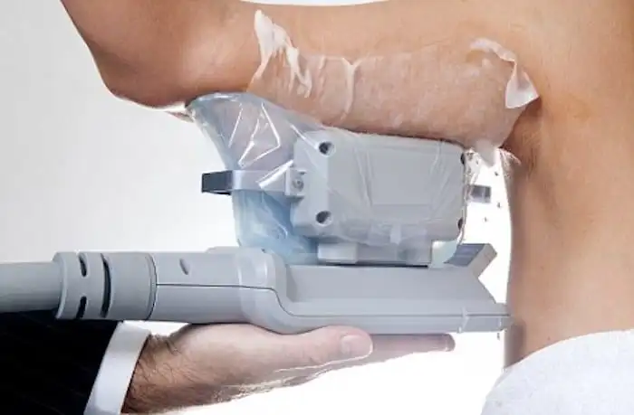 Picture of fat freezing Milton Keynes on the upper arms.