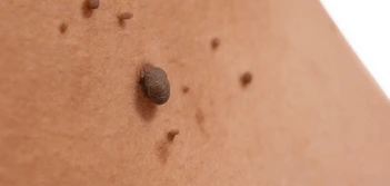 image of a skin tag Milton Keynes