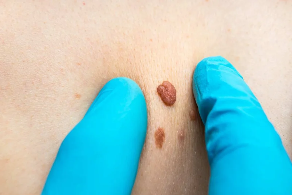 Consultant examining a skin tag Milton Keynes