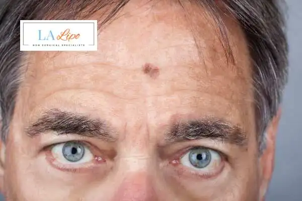 Solar Lentigo Removal Milton Keynes image of man with mark on his forehead