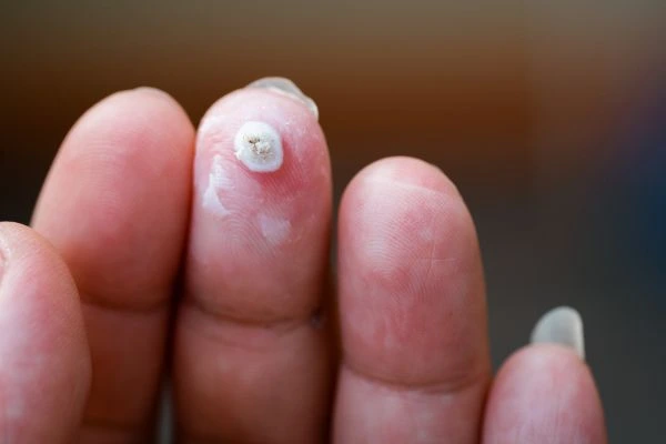 wart on person finger - cryotherapy to treat from LA LIPO Milton Keynes