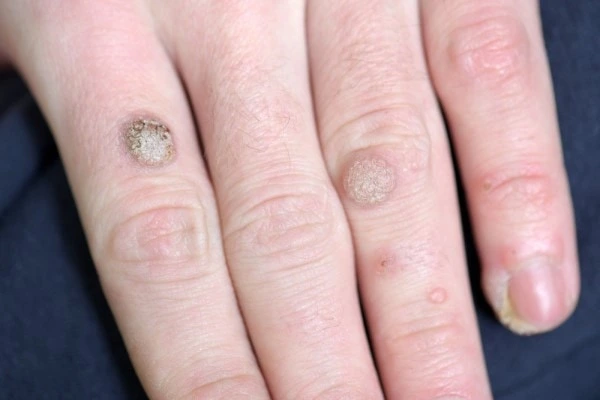 photo of warts on person hand - see wart removal Milton Keynes from LA LIPO
