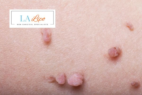 Does cryopen skin tag removal Milton Keynes hurt? Find out now call our team today!