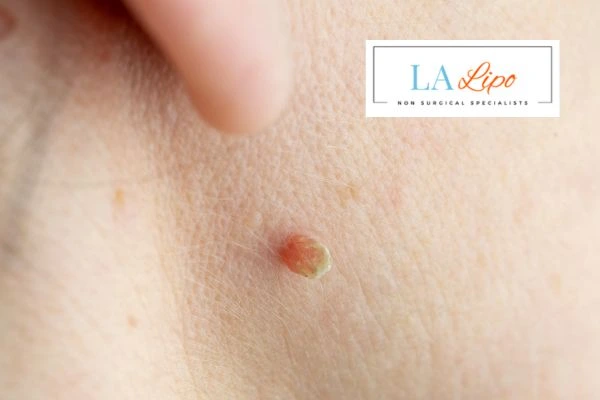 Book skin tag removal Milton Keynes today speak to our team now!