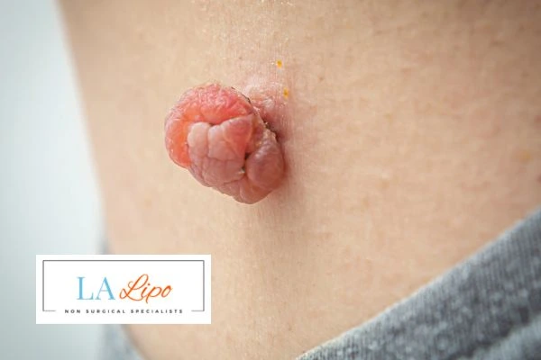 Interested in skin tag removal Milton Keynes? Concerned about the pain? Find out more today!