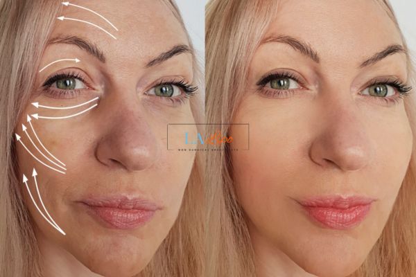 Morpheus 8 results Milton Keynes face lift.