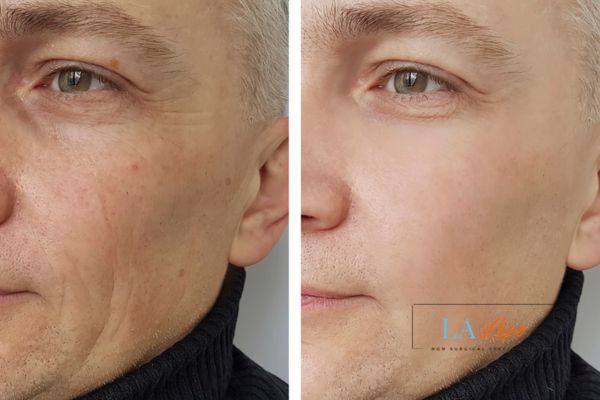 See the amazing results of Morpheus8 Treatment Milton Keynes!