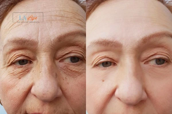 The powerful benefits of Morpheus8 Treatment Milton Keynes - Call Our team today!