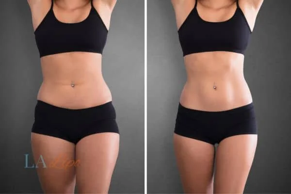 before and after results of non-surgical treatment to help a woman's body image and mental health Milton Keynes