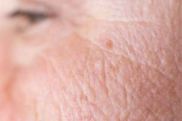 close up picture of a woman's face showing an age spot Milton Keynes