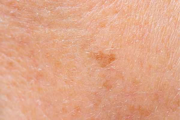 close up picture of age spots Milton Keynes