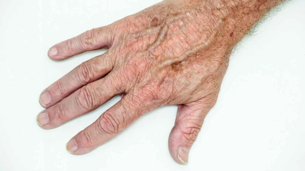 Male hand showing age spot Milton Keynes