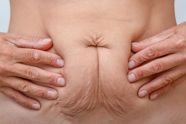 Image of a woman's stomach with loose skin - example of skin tightening Milton Keynes options