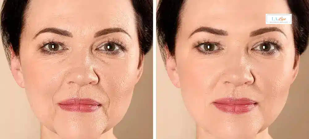 How Long Does It Take to See Results and How Long Do They Last Milton Keynes?