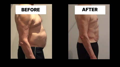 What Symptoms Can Diastasis Recti Cause in Men? Weak Core, Back Pain and Poor Posture Milton Keynes